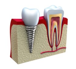 Dental Implants For Missing Teeth in plano, texas