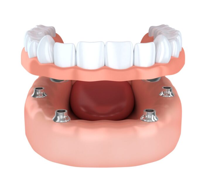 All-on-Four dental implants in Plano TX