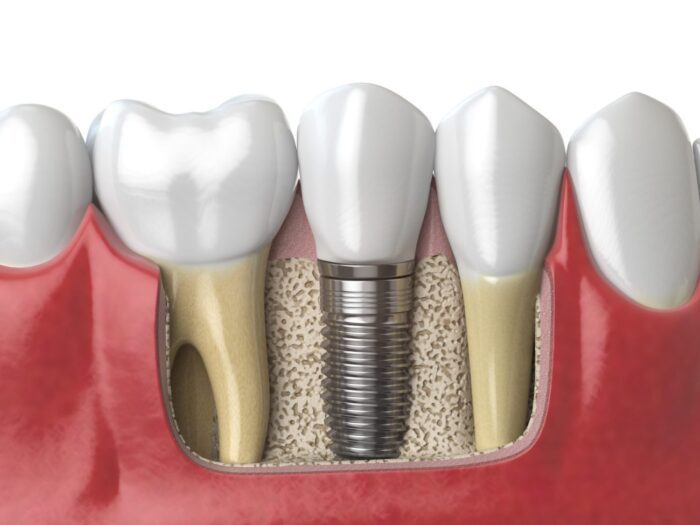 Affordable Dental Implants in Plano, TX