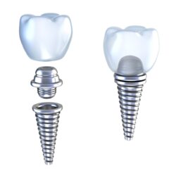 dental implant in plano tx
