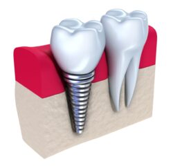 dental implants in plano tx