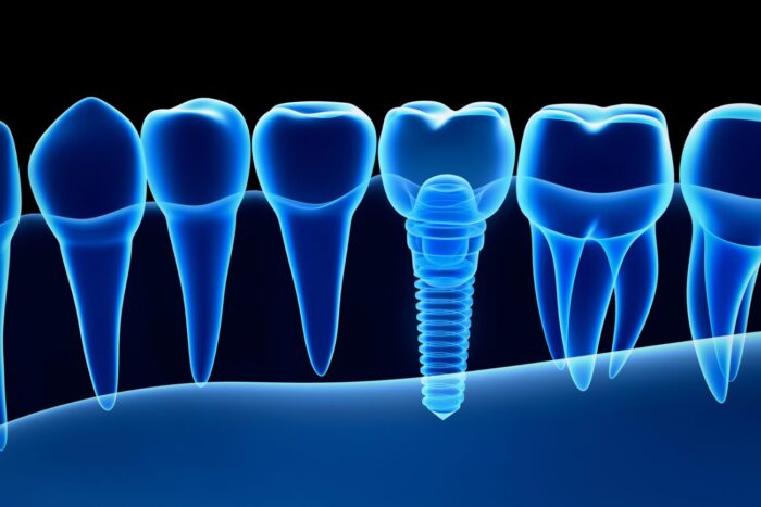 dental implants cost near me in Plano Texas