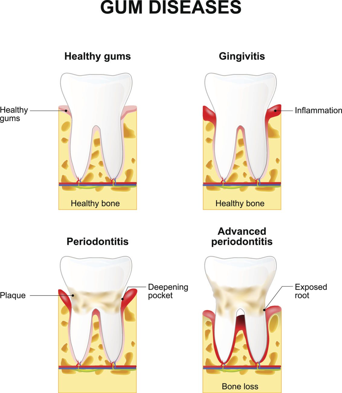 periodontitis progression in plano, texas