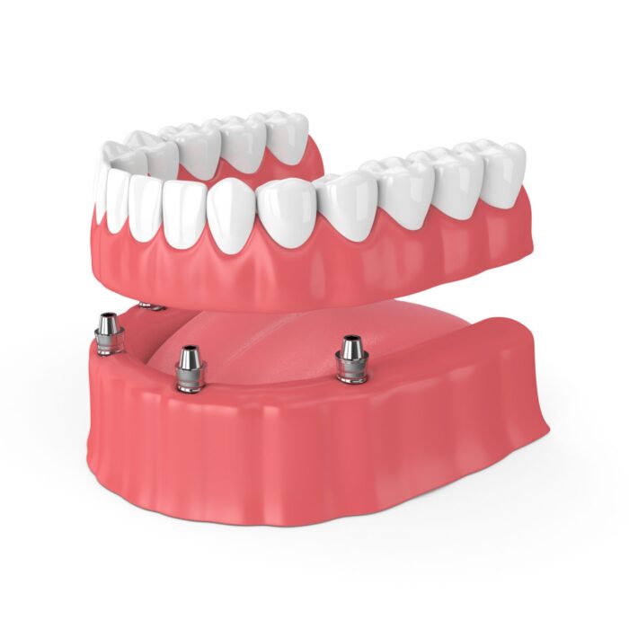implant-retained dentures in Plano, Texas