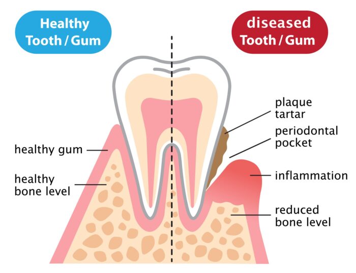 signs of periodontal disease in Plano Texas