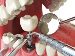 affordable dental implants in plano, texas