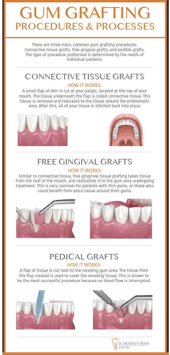 Gum Grafting Options in Plano, Texas