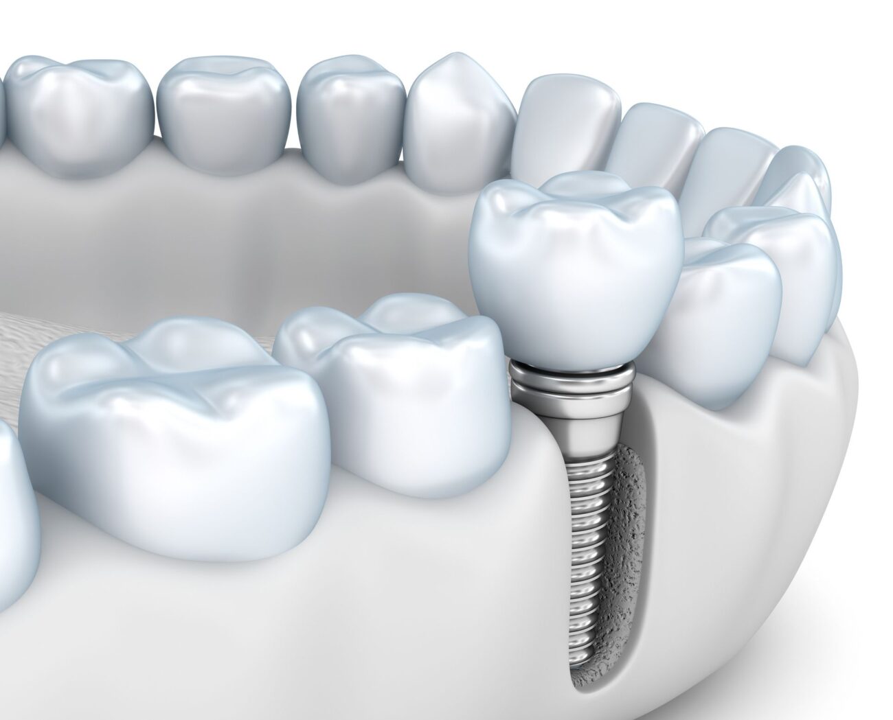 dental implants and jawbone health in Plano Texas
