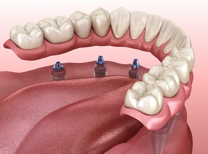 implant dentures in Plano Texas