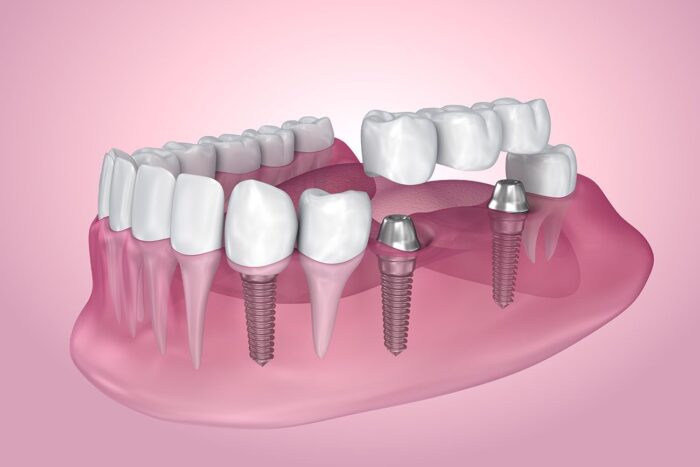 multiple dental implants Plano Texas