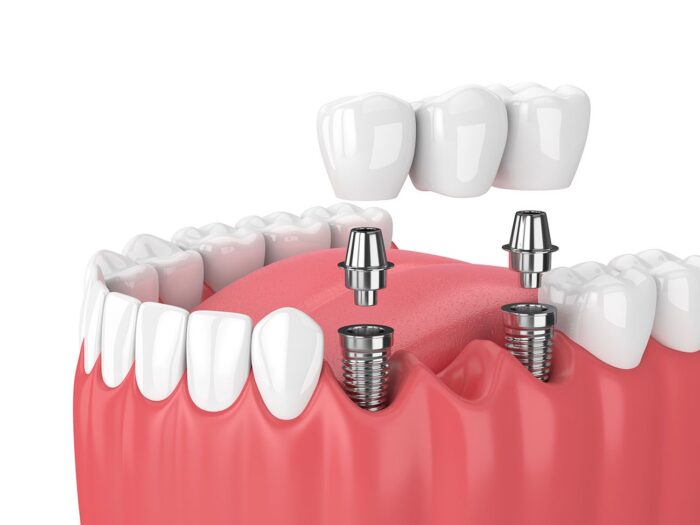 types of dental bridges Plano Texas
